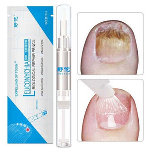 Anti Fungal Treatment Nail Pen Onychomycosis Paronychia Infection Herbal Toe Finger Nails Health Nail Fungus Treatment Massage